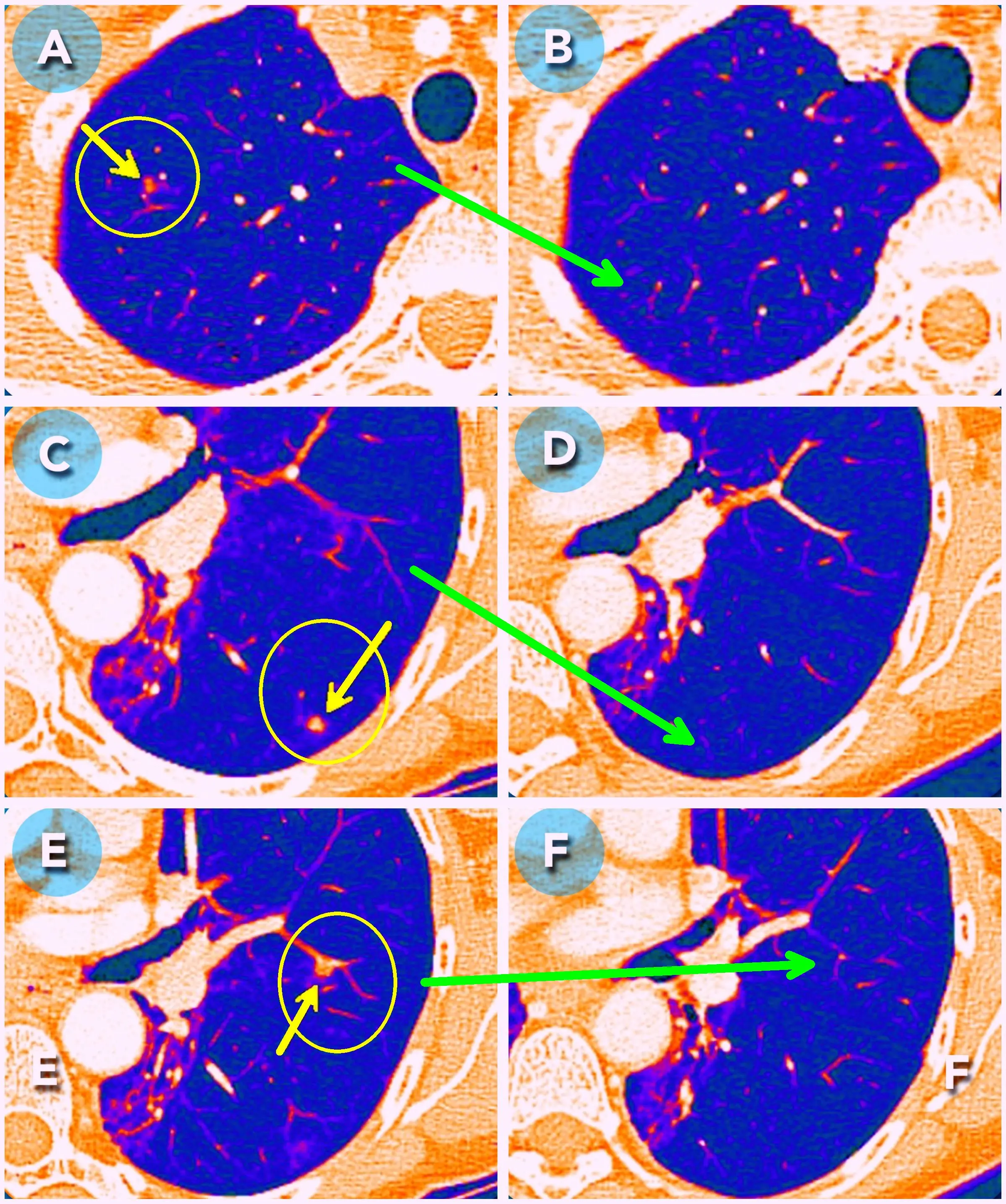 Tomografías de tórax de Alice B. con lesiones pulmonares antes y después del tratamiento.