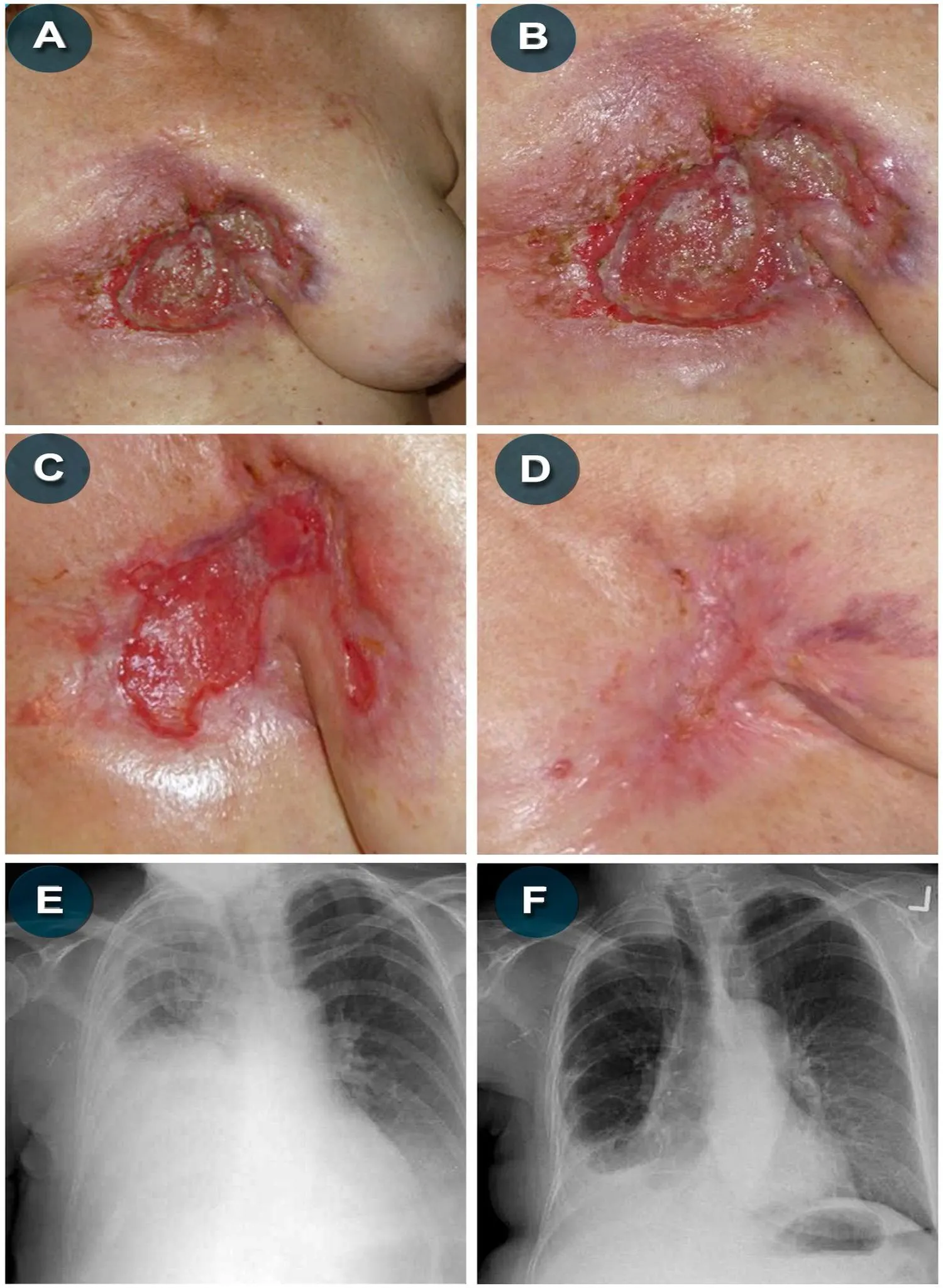 Secuencia clínica de Susan con imágenes A a F de cáncer de mama recurrente y estudios torácicos.